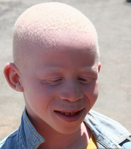 Copil cu albinism