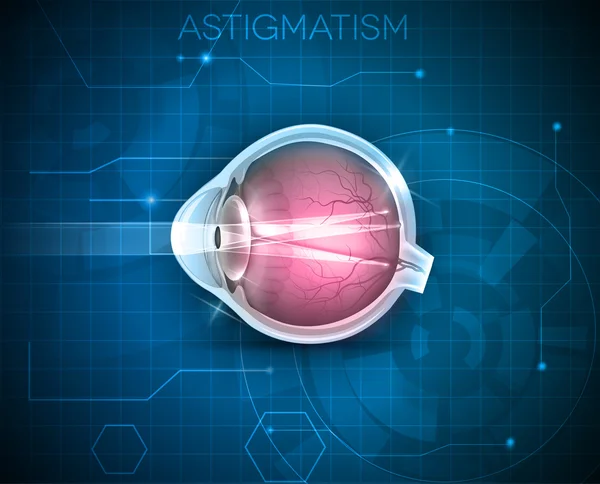 Astigmatism