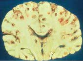 Creier. Neurocisticercoza